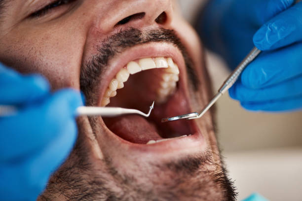 Best Emergency Treatment for Oral Infections in Huntington Beach, CA