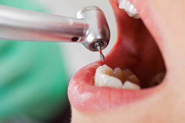 Best Emergency Wisdom Tooth Extraction in Huntington Beach, CA